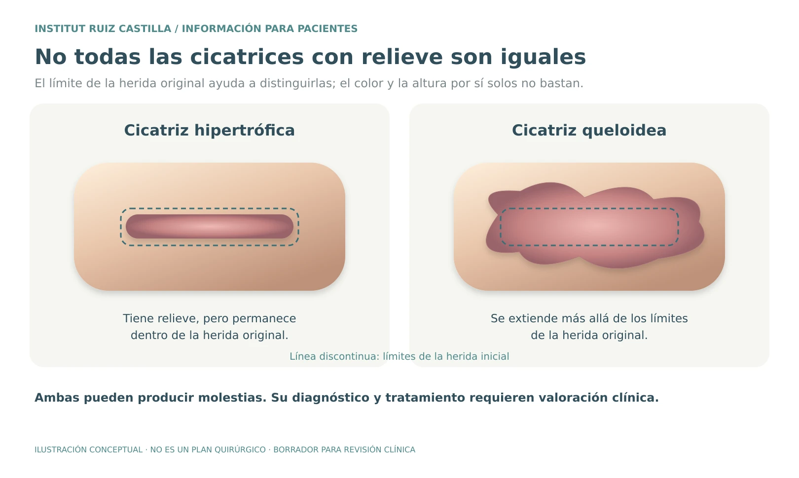 Diferencias entre cicatriz hipertrófica y queloide