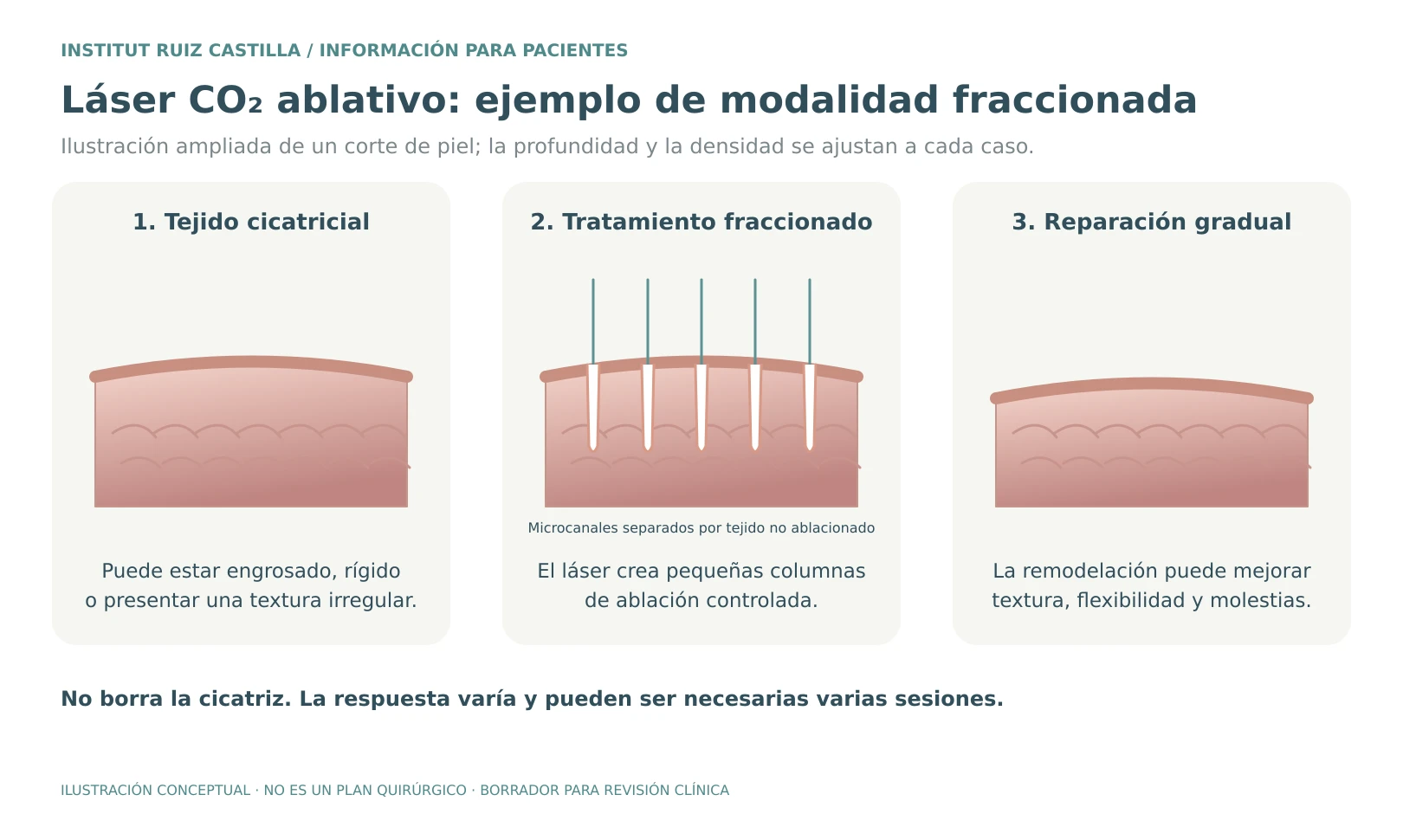 Tratamiento con láser de CO₂ fraccionado