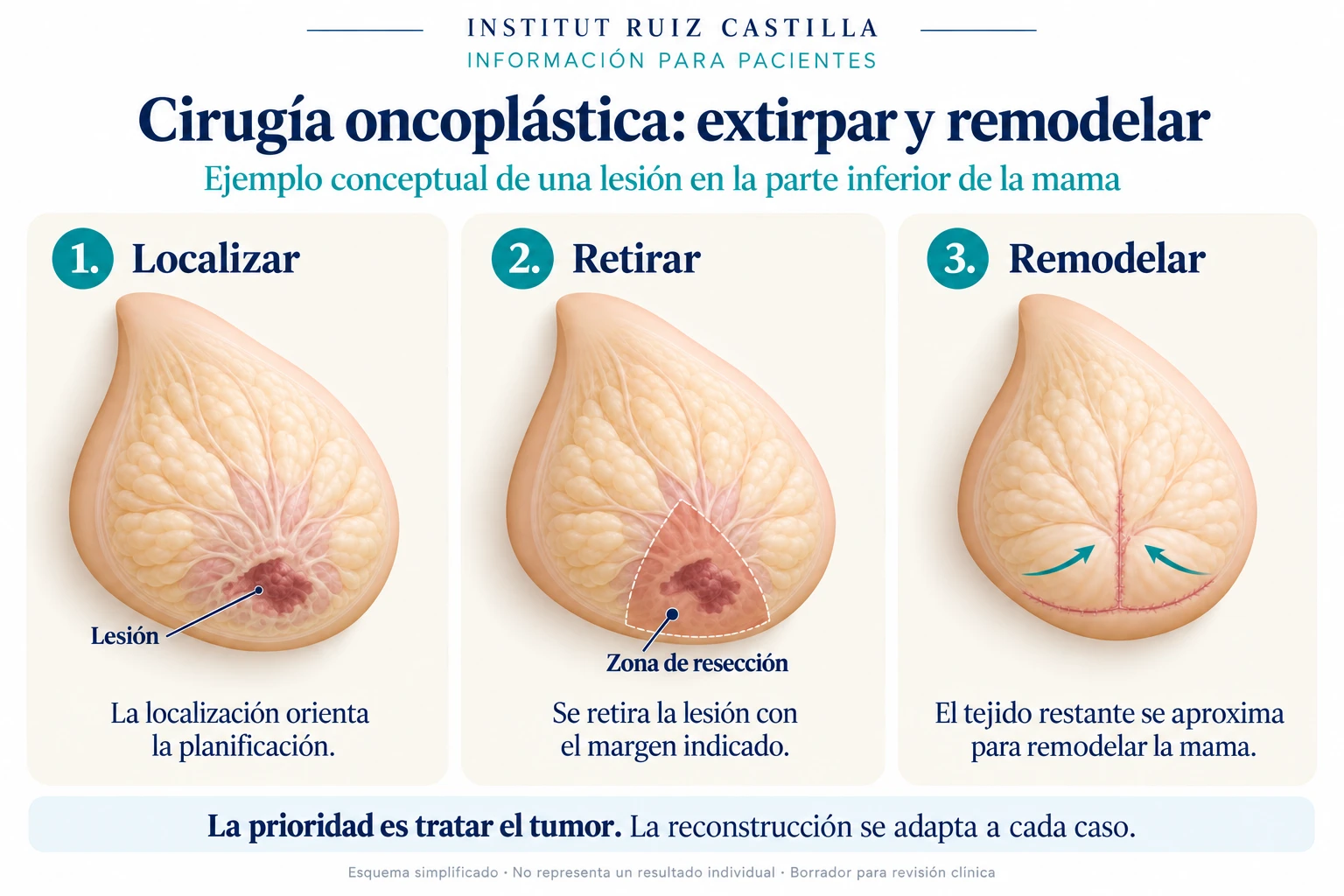 Cirugía oncoplástica: extirpar y remodelar