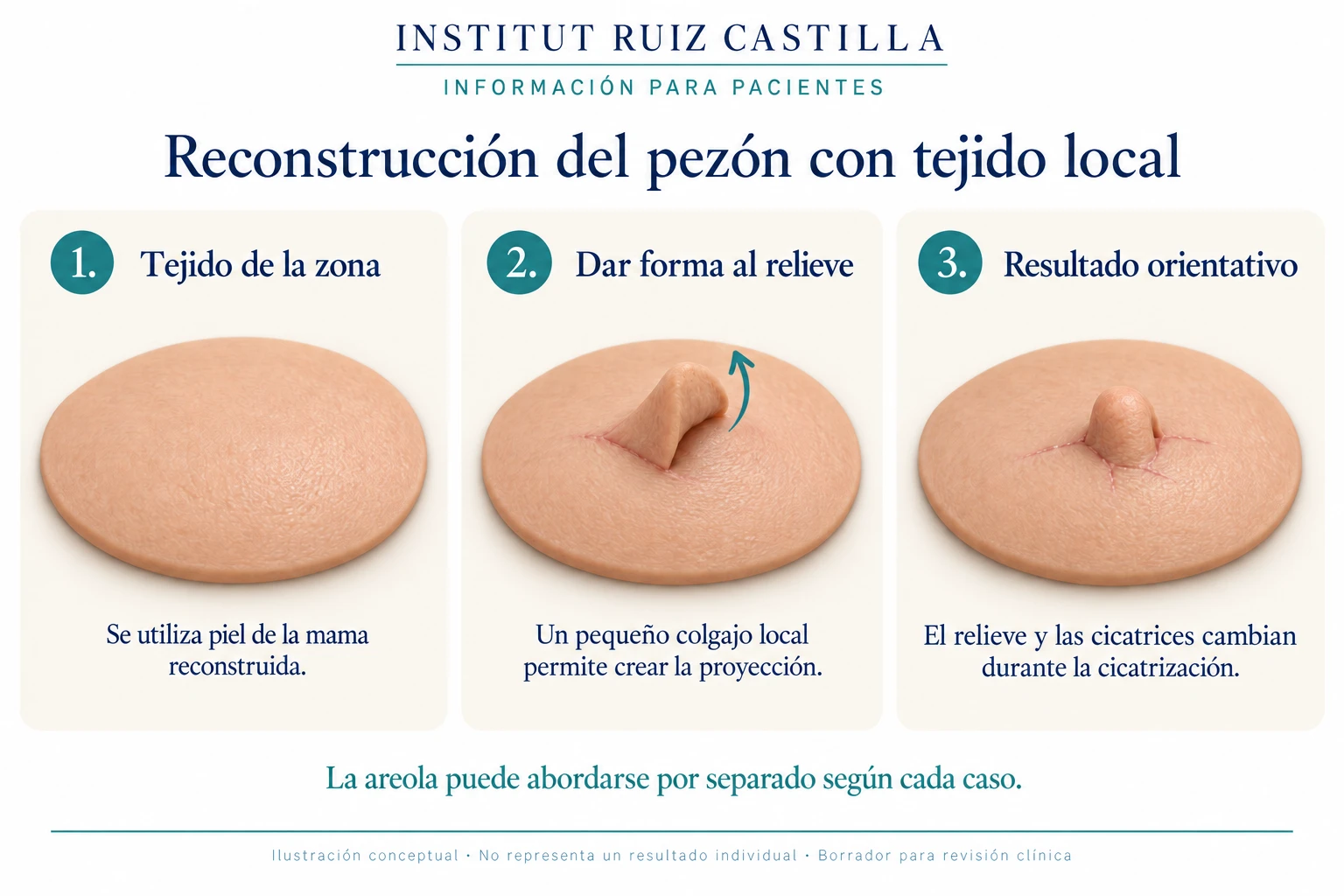 Reconstrucción del pezón con tejido local
