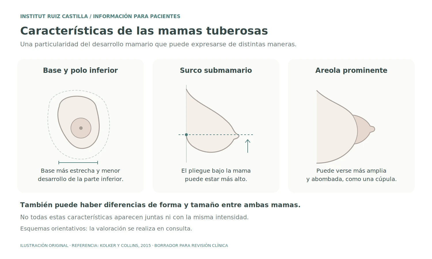 Características de las mamas tuberosas