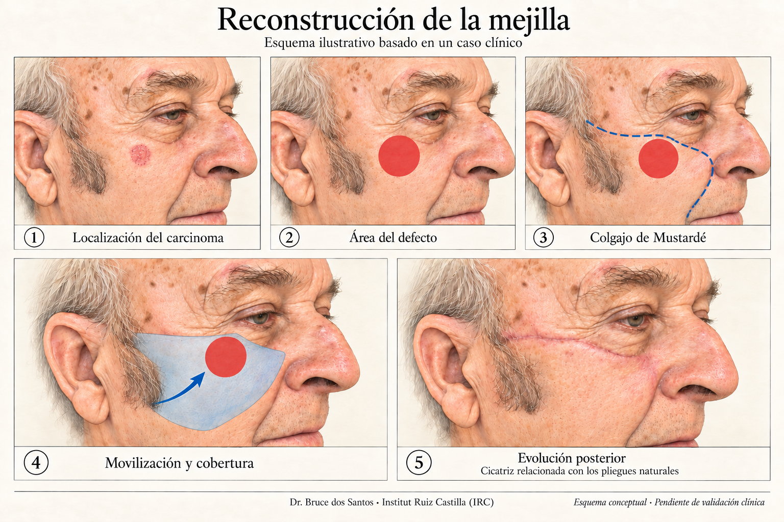Reconstrucción de la mejilla con colgajo de Mustardé · Ilustración validada